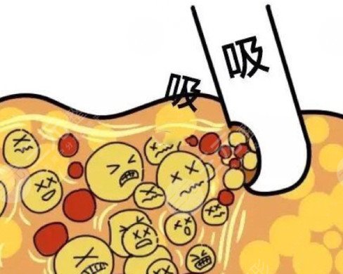 副乳吸脂