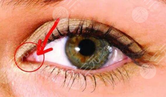 淚阜完全暴露的人不適合開(kāi)眼角