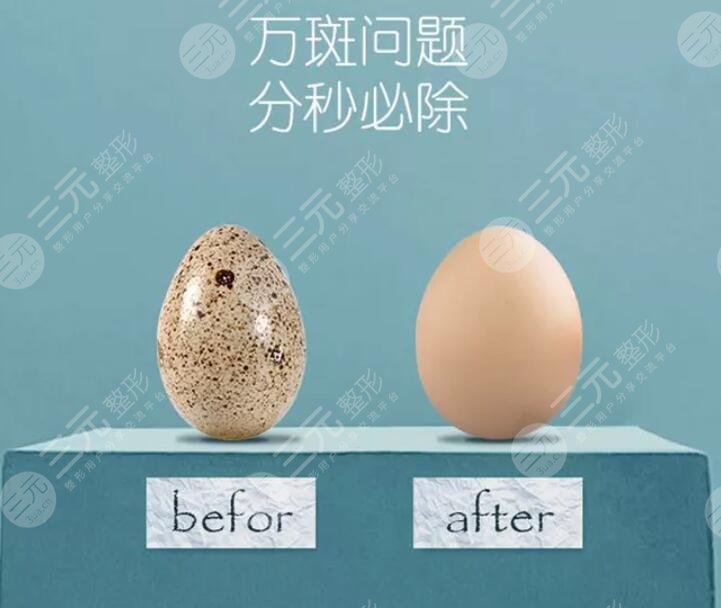 激光祛黃褐斑的價格