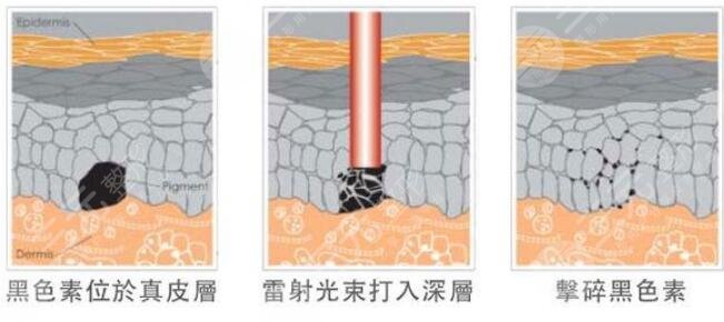 激光祛黃褐斑后的注意事項