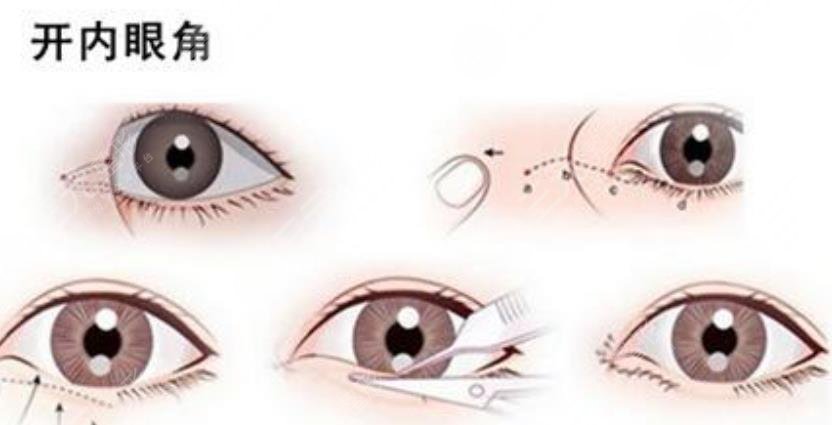 開眼角留疤可能性大嗎？開眼角的注意事項(xiàng)本文都告訴你，術(shù)前了解