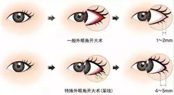 什么是開外眼角