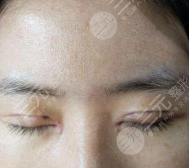 開眼角留疤可能性大嗎