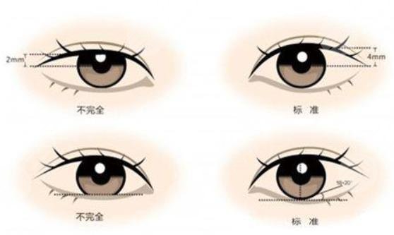 做雙眼皮手術(shù)疼嗎？手術(shù)的注意事項(xiàng)有哪些？你需要注意這些...