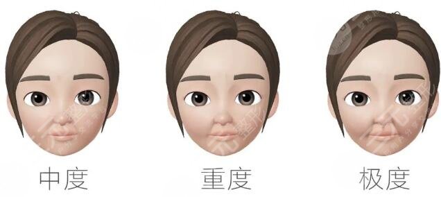 鼻唇溝填充需要幾支？科普：注射美容搞定你的法令紋！