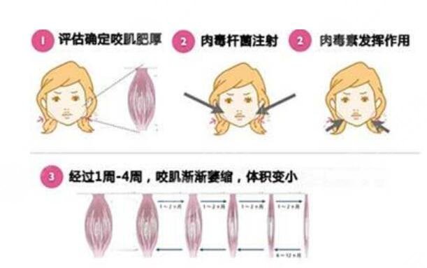 注射瘦臉的原理是什么
