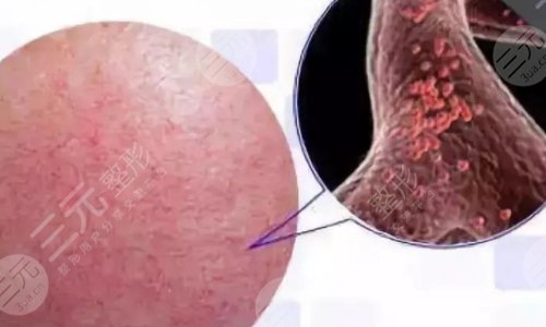 如何緩解面部紅血絲？光子、激光如何選擇？