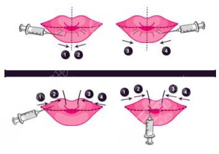 非手術(shù)整形