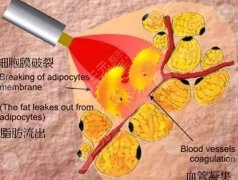 光纖溶脂好不好？光纖溶脂的價(jià)格是多少？光纖溶脂瘦腿案例