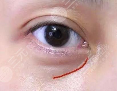 怎樣有去除眼袋的方法有哪些