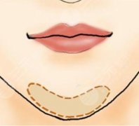 墊下巴多久消腫一般？墊下巴的價(jià)格是多少？真實(shí)墊下巴案例果
