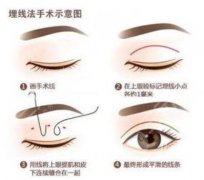 做雙眼皮手術(shù)恢復(fù)時間查詢，雙眼皮手術(shù)價格+雙眼皮案例果
