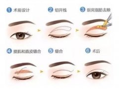 割雙眼皮好還是埋線好？不怕糾結(jié)癥，“亙古難題”為你解答！