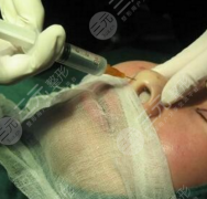 注射隆鼻的材料有那些？注射隆鼻的好處和優(yōu)勢有哪些？