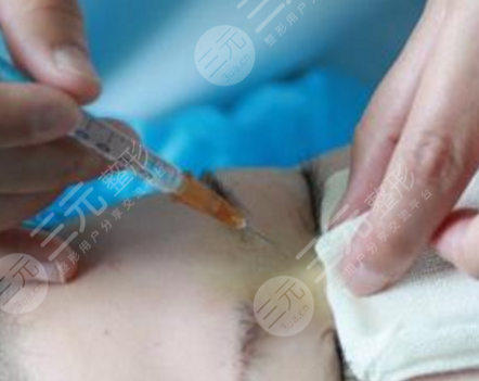 注射隆鼻的材料有哪些