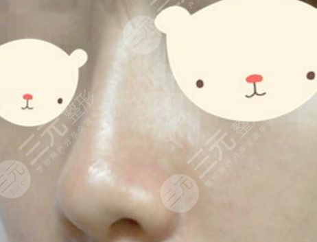 注射隆鼻的好處和優(yōu)勢有哪些