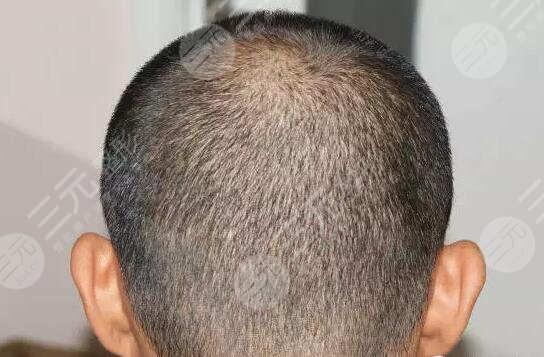 植發(fā)手術(shù)需要多少費(fèi)用