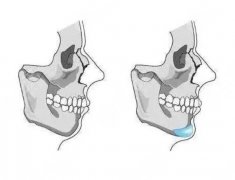 假體隆下巴價(jià)格多少錢？想get精致輪廓，科普&案例參考！