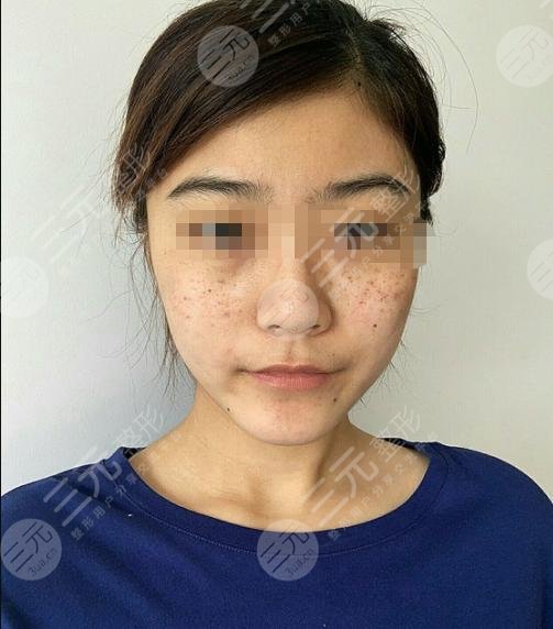 黑臉娃娃嫩膚后半個月