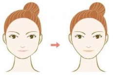 下頜角磨骨術(shù)多少錢？恢復(fù)過程圖分享，揭秘ta是否值得花錢！