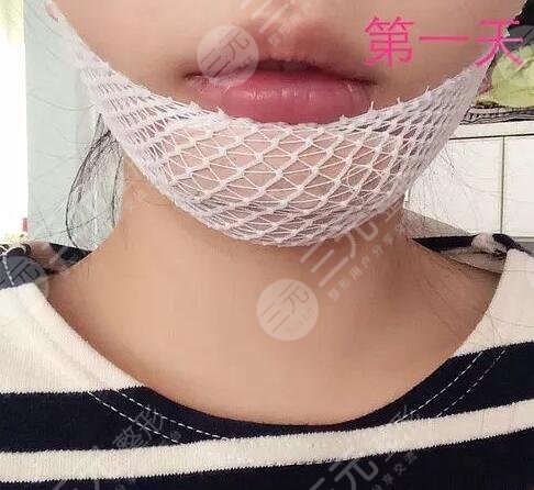 真人墊下巴后1天