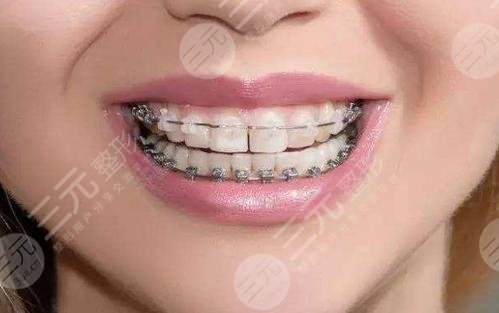 牙齒矯正步驟流程大揭秘：解決牙齒擁擠、齙牙、牙縫牙凸~