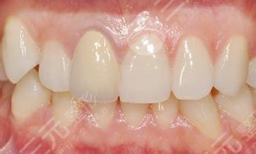 四環(huán)素牙會遺傳嗎？可以從這幾個方面避免，恢復閃亮笑容~