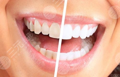 四環(huán)素牙會(huì)遺傳嗎