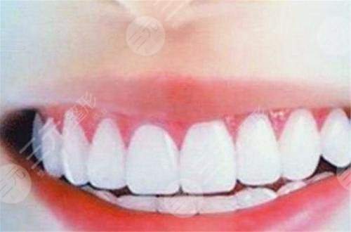 明星牙齒怎么那么白