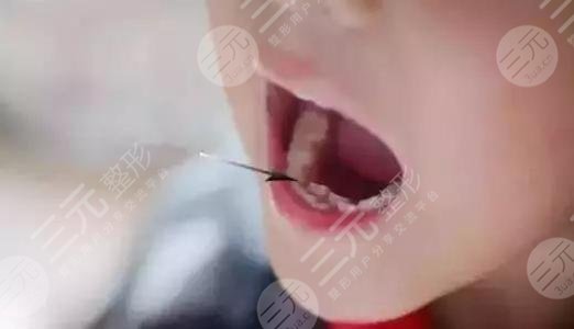 乳牙滯留怎么辦