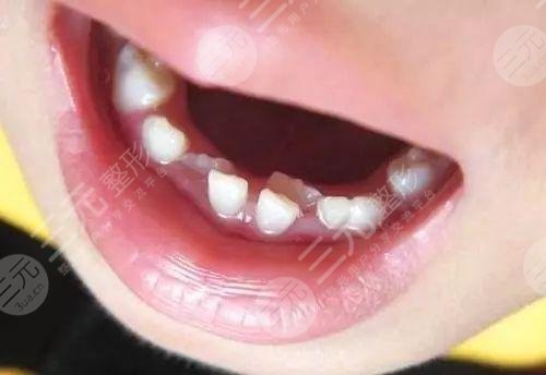 乳牙滯留怎么辦