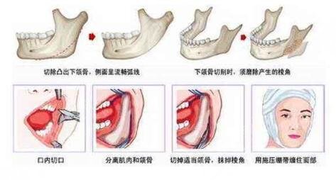 什么是下頜角切除