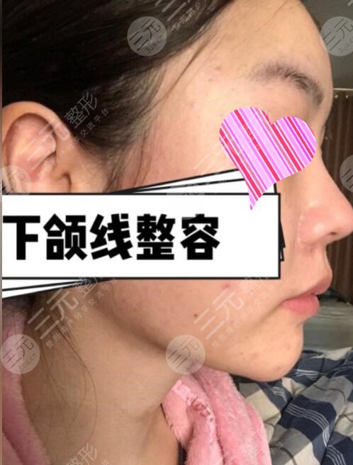 下頜角手術(shù)前