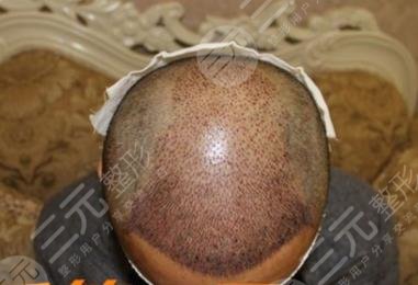 深圳流花醫(yī)院植發(fā)科植發(fā)經(jīng)歷分享