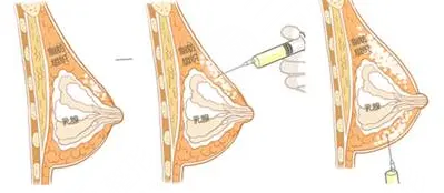 上海注射隆胸修復(fù)價(jià)格影響因素大揭秘，花一分鐘了解一下~