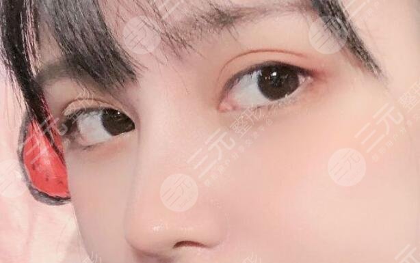 自體軟骨隆鼻成好嗎？自體軟骨隆鼻多少錢？真人案例果