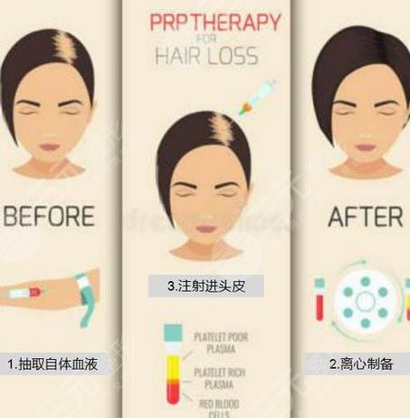 cgf緩解脫發(fā)注射幾次見