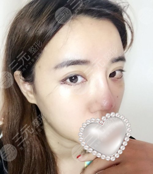 開外眼角3mm圖片