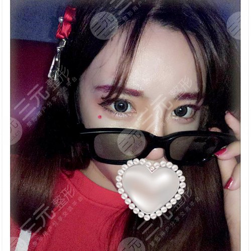 開外眼角3mm圖片