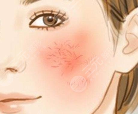 臉上紅血絲如何去除？怎么修復(fù)？