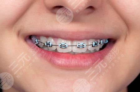 5類人不能做牙齒整形