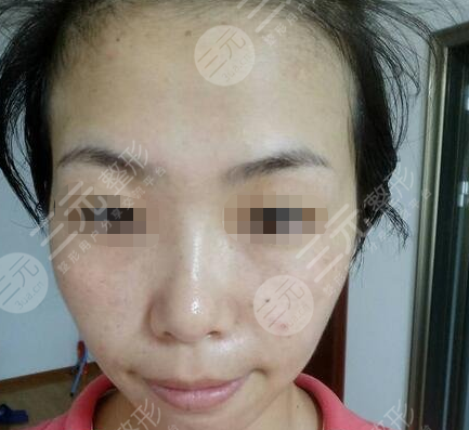 九院激光pm激光祛斑價格