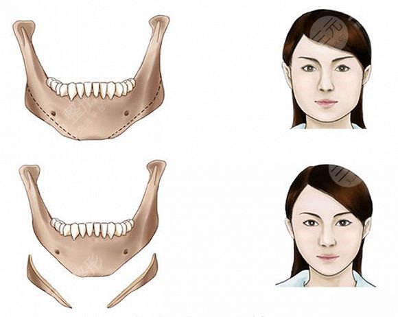 磨骨手術(shù)的原理
