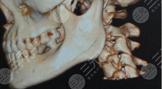 必看！磨骨手術(shù)臉要腫幾個月？想做磨骨手術(shù)注意事項得先清楚~