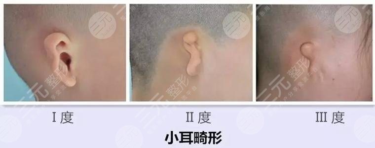 耳再造多少費(fèi)用