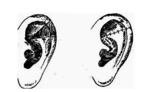 耳再造多少費(fèi)用