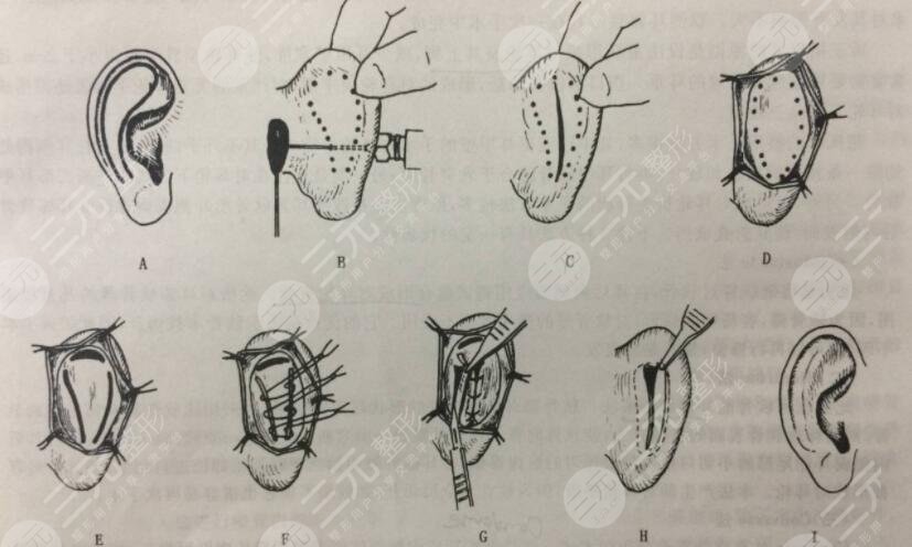 顱耳角在30°-60°之間是一種天生畸形，矯正方法如下