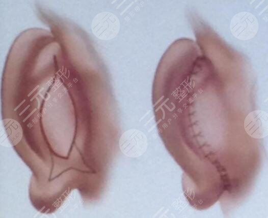 顱耳角在30°-60°之間整形矯正