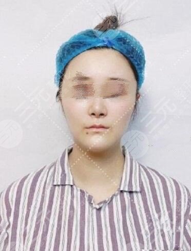 顱耳角在30°-60°之間整形前