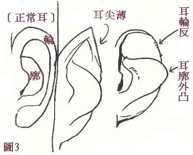 顱耳角在30°-60°之間朵怎么整形